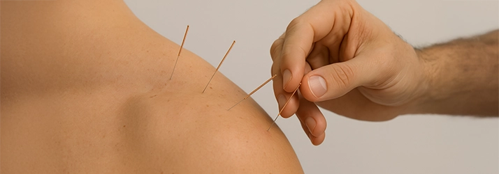 Chiropractic Parker CO Dry Needling On Shoulder